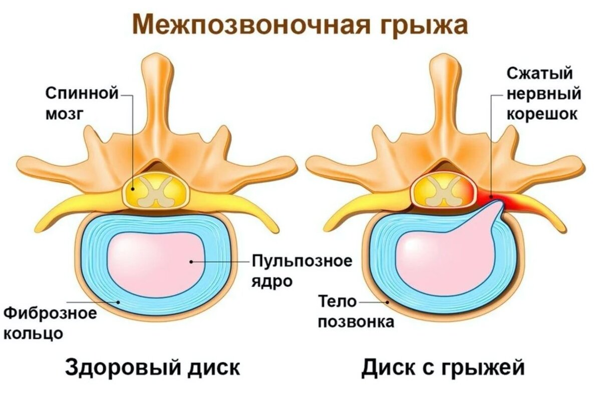 Грыжа позвоночника