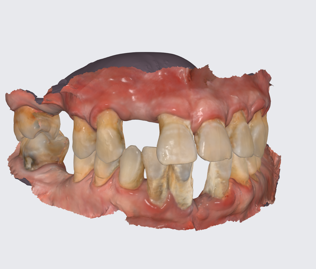 Хронический пародонтит тяжёлой степени тяжести, цифровой слепок челюстей