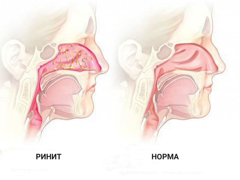 Блог№3 Вазомоторный ринит | Совет оториноларинголога | Дзен