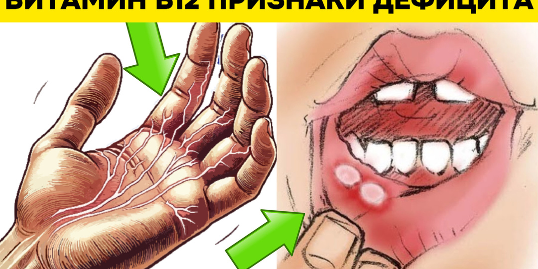 10 признаков дефицита витамина В12, на которые должен обратить внимание каждый диабетик