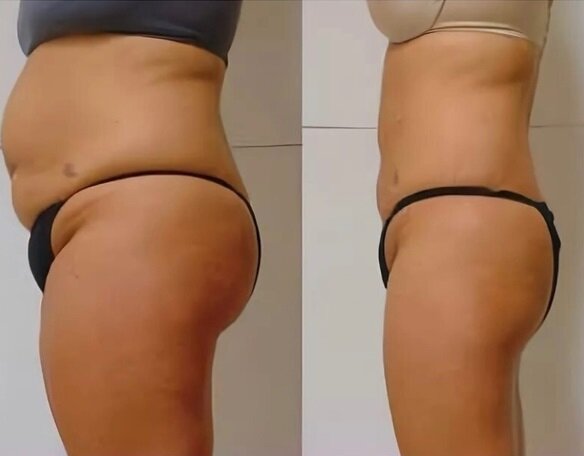 ДО и ПОСЛЕ курса процедур