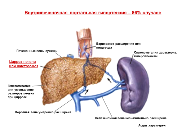 Операция ТИПС при портальной гипертензии - Инновационный сосудистый центр
