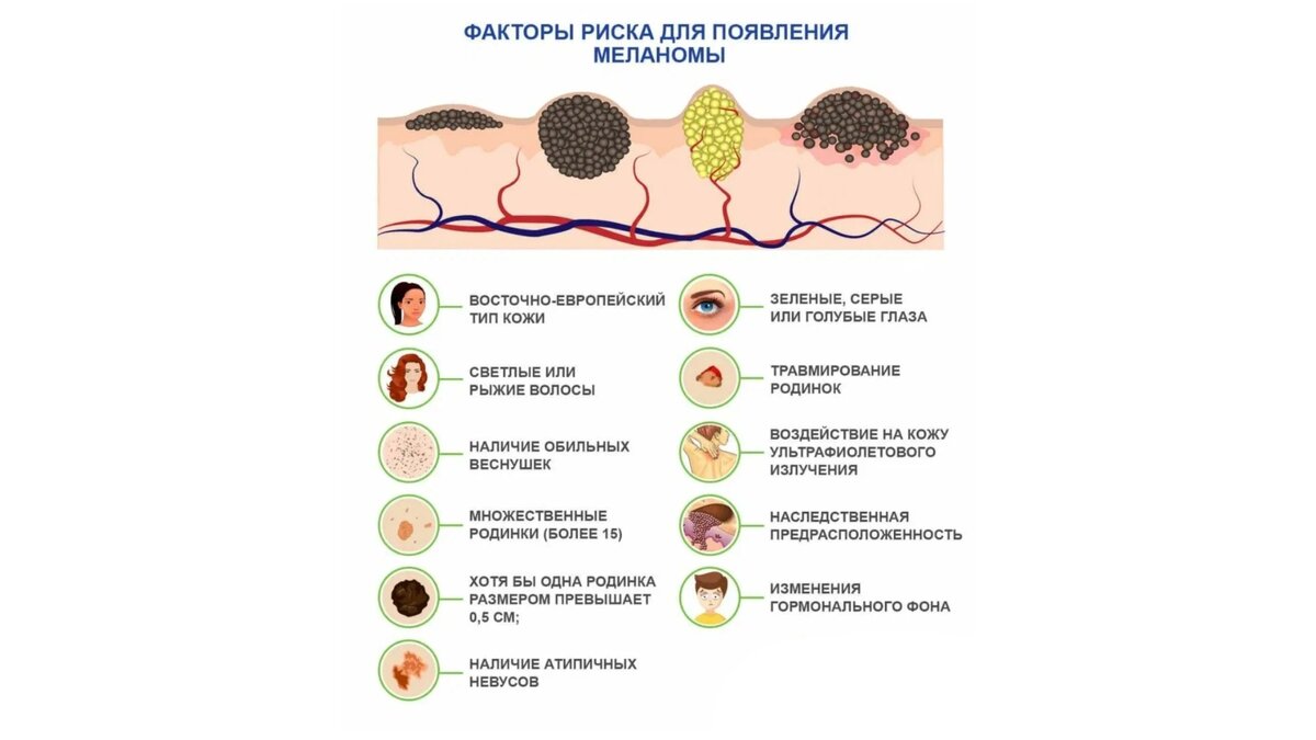 Какие родинки опасны для здоровья человека фото Что такое меланома и как не пропустить у себя "королеву" онкологии ? Топ-5 отлич