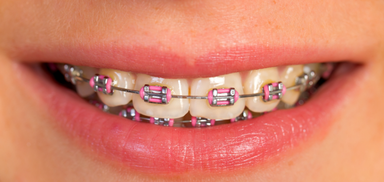 Лигатурные брекеты