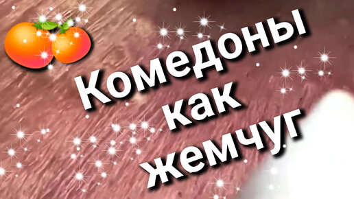 Косметолог чистит лицо от комедонов или добывает жемчуг? 🍊 Их очень много...