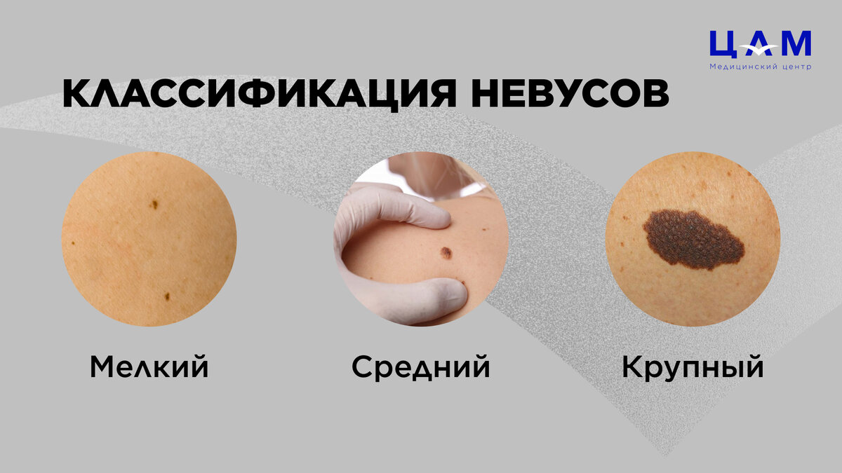 Новообразования кожи