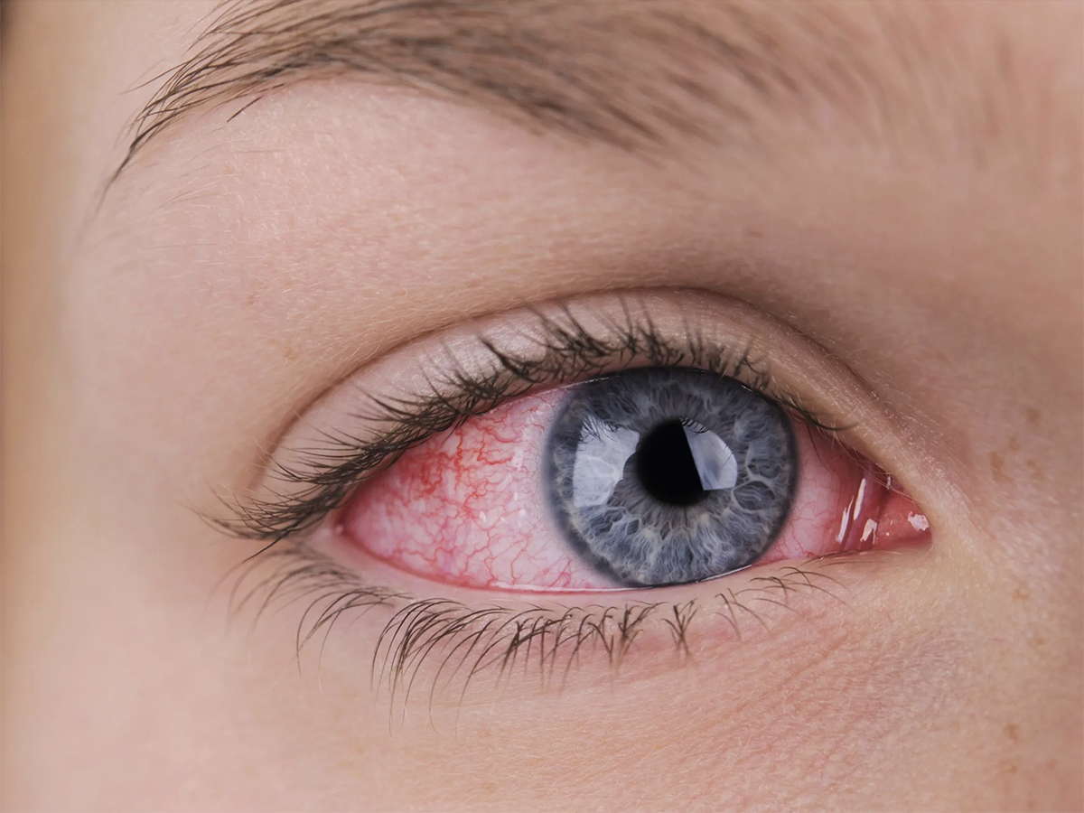 Покраснение глаз считается распространенной жалобой. Мы чаще обращаем внимание на такую особенность после сильной усталости или длительной работы у компьютера.