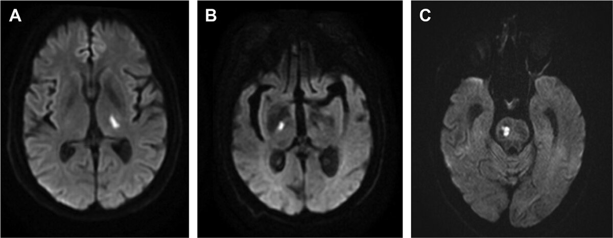 Инфаркты размером менее 20 мм в типичных для инфарктов мелких сосудов местах соответствуют лакунарным инфарктам. ( А ) Аксиальная диффузионно-взвешенная МРТ демонстрирует острый инфаркт левого таламуса у курильщика с гиперлипидемией. ( Б ) Аксиальная диффузионно-взвешенная МРТ демонстрирует острый инфаркт правой внутренней капсулы у пациента с множественными сосудистыми факторами риска. ( C ) Аксиальная диффузионно-взвешенная МРТ демонстрирует острый инфаркт правого моста у пациента с гиперлипидемией и гипертонией.