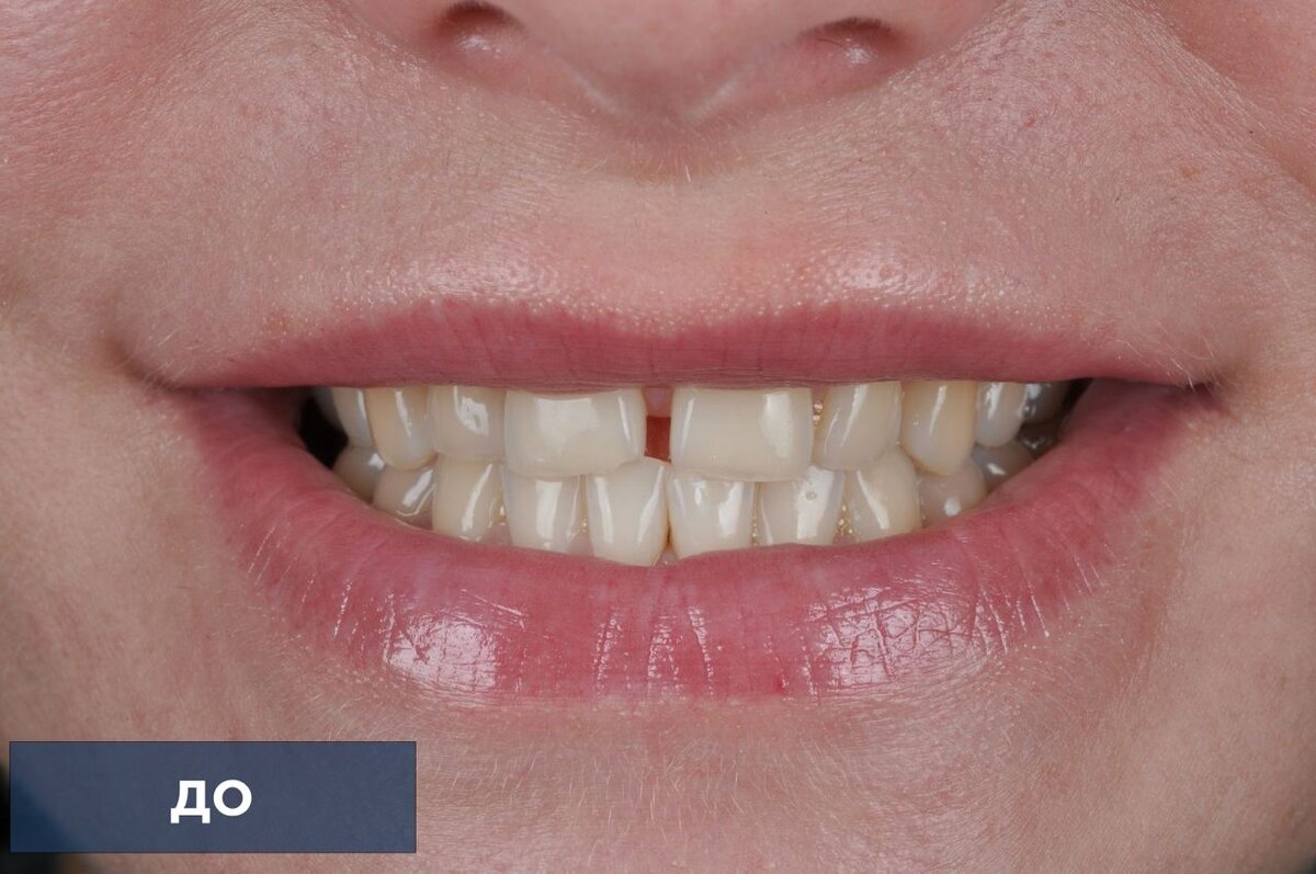  Пациентка обратилась с жалобами на стираемость зубов и неудовлетворенность внешним видом улыбки.-2