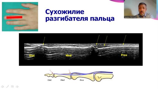 Чем полезны функциональные пробы при ультразвуковом исследовании кисти?