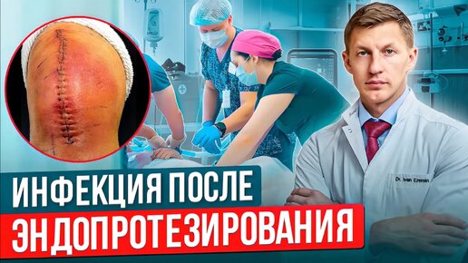 Страшные последствия после эндопротезирования. Воспаление после операции по замене сустава. Нагноение