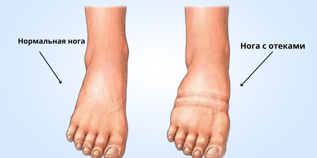 Если отеки не проходят — ищите проблему глубже: от почек до гормонов