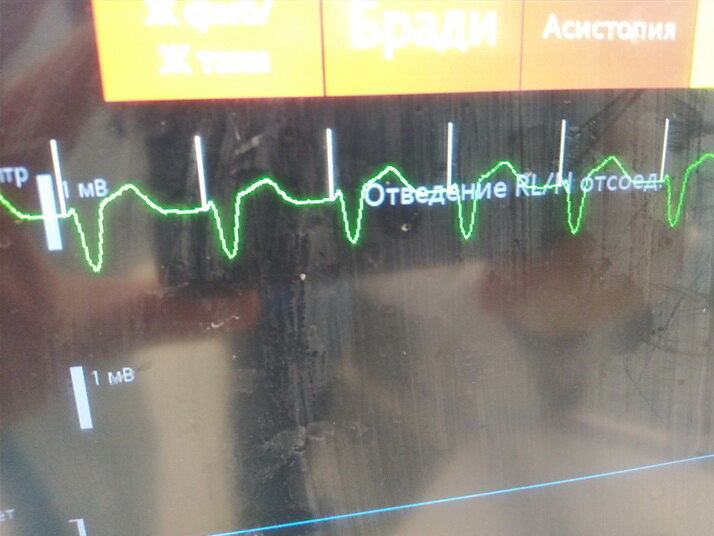 Белые вертикальные линии - это импульсы стимулятора. После каждого импульса следует сокращение сердца, оно отображено зелёным цветом. Картинка радует глаз, но, чтобы добиться такого результата, пришлось поработать.