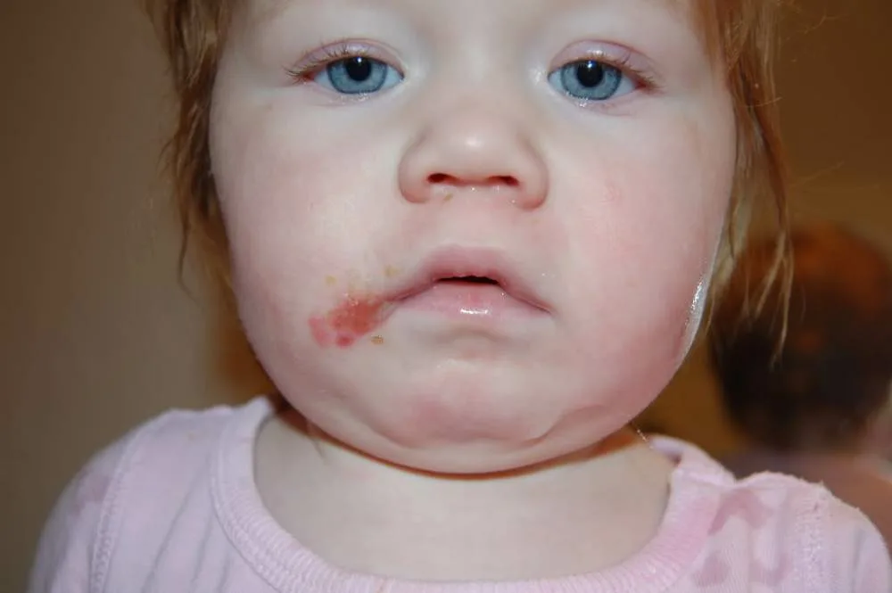 Strange Bumps Affect Millions, But Treating Them Is As Simple As Rubbing Honey O