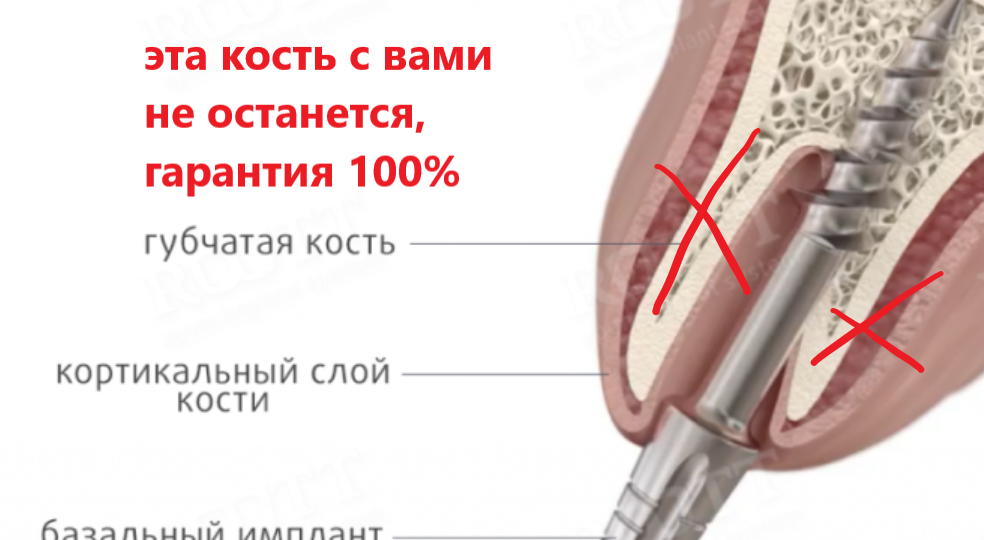 Базальная имплантация - спасение, грозящее необратимым уроном. Сравнение с привычными имплантатами и методикой "всё на 4"