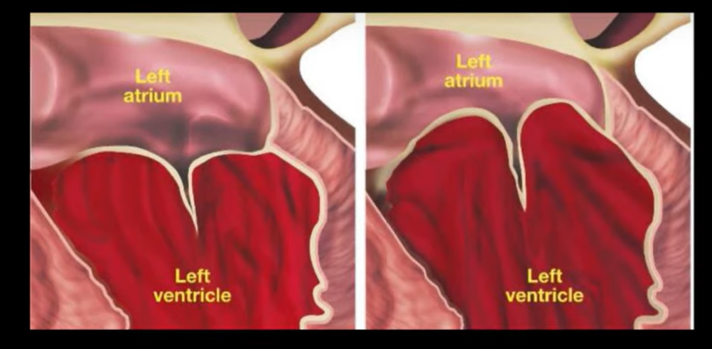 Слева вы можете видеть нормальный митральный клапана, а справа, что с ним происходит при пролапсе- створки перерастягиваются при сокращении сердца