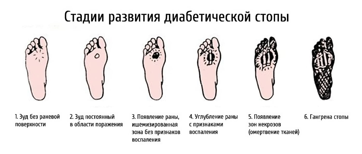 Как предотвратить поражения стопы при диабете, развитие инфекций и язв, которые могут привести к ампутации.-3