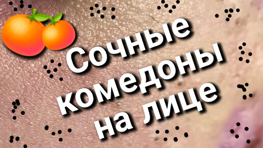 Косметолог выдавливает СОЧНЫЕ комедоны на лице 🍊