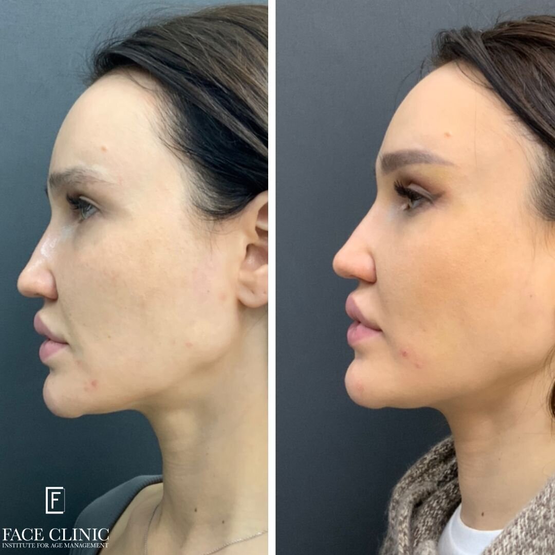 Безоперационная ринопластика носа До и После | Face Clinic | Клиника  косметологии в Москве | Дзен