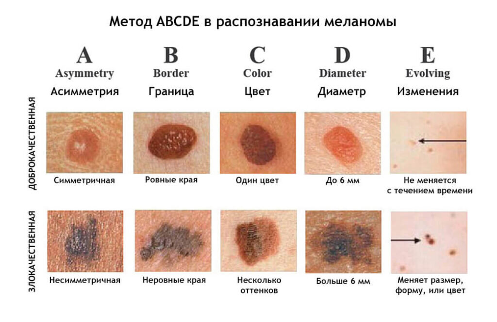 Признаки меланомы