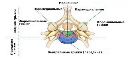 Расположение грыж МПД относительно позвонка