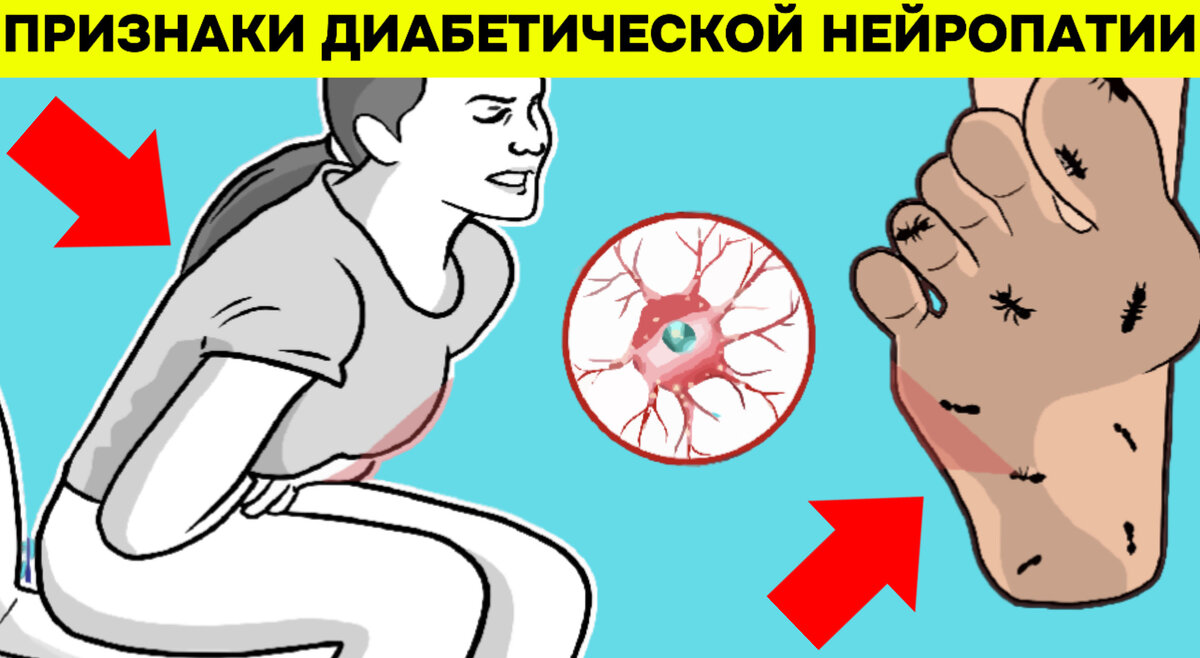 Известно ли вам, что диабет может привести к повреждению нервов?