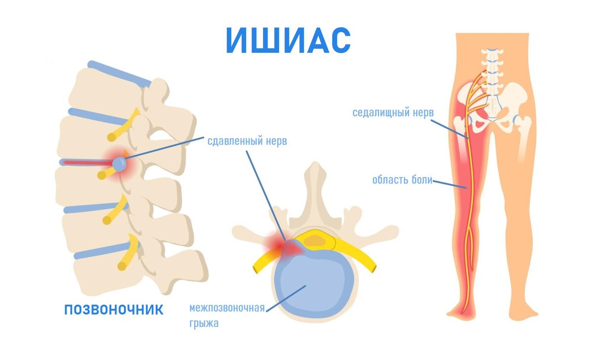 Блокада при ишиасе | Ист Клиник | Дзен