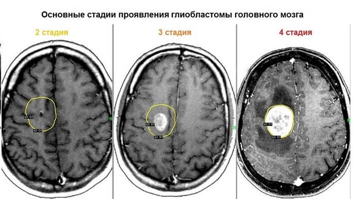 Новая мРНК-вакцина против самого агрессивного рака мозга, глиобластомы, после первых клинических испытаний на людях показала отличный результат: активная реакция иммунной системы, запускающая борьбу с-2