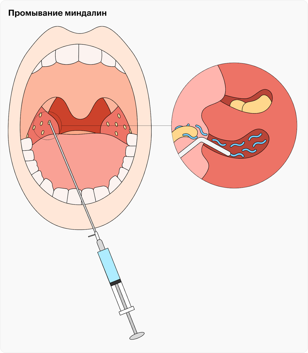 Почему в миндалинах образуются пробки и что с ними делать | Evolutis Clinic  | Дзен