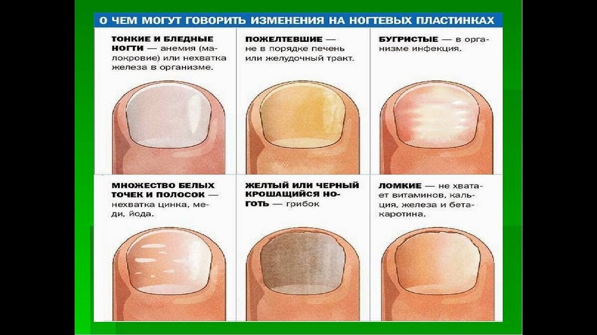 По фото определить заболевание ногтей Советы бывалого: Зеркало желудка Просто фантастика Андрея Сульдина Дзен