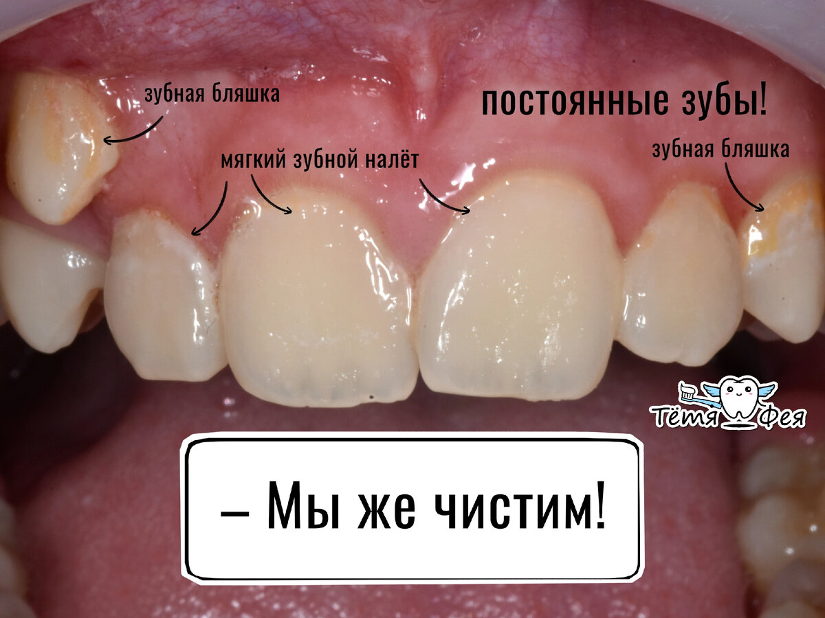 На фото постоянные зубы: 
– обильный мягкий зубной налёт (хотя ребёнок дома почистил зубы!) ;
– ярко-желтые зубные бляшки, которым уже несколько дней ;