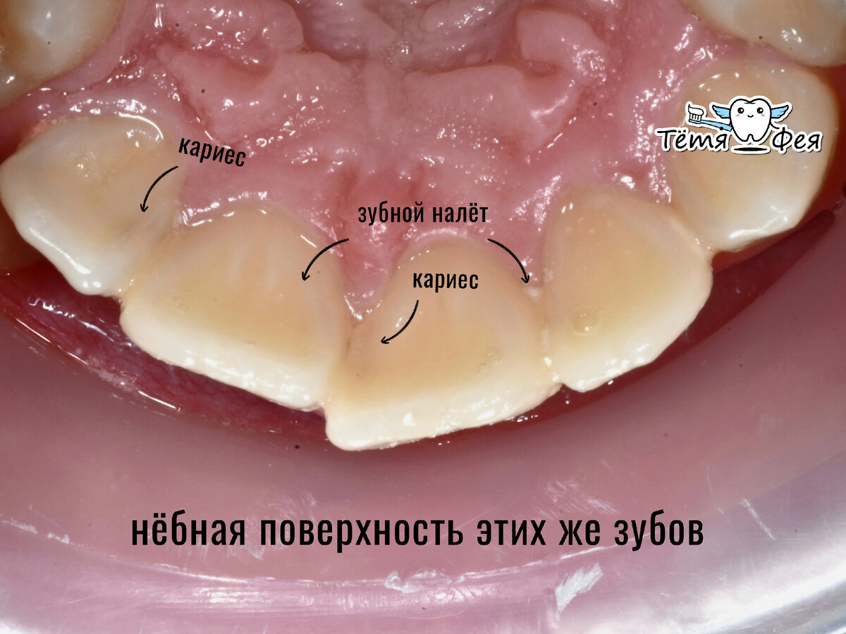 – между зубов просвечивает КАРИЕС, заметить его дома абсолютно НЕВОЗМОЖНО, ведь жалоб никаких нет! 