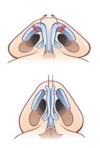 Пример пластики кончика носа: сужение слишком широкого кончика
