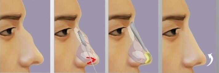 Пластика горибнки носа