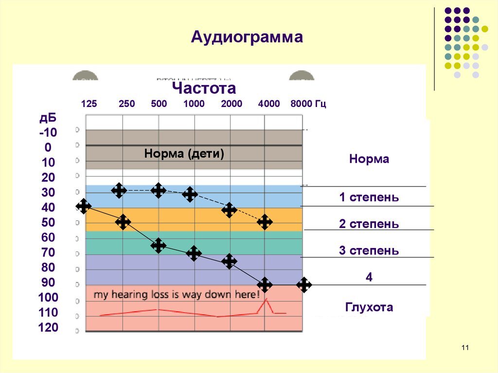 Так выглядит аудиограмма