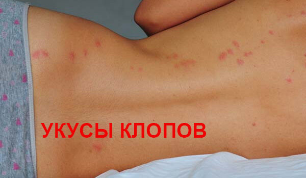 укусы клопов