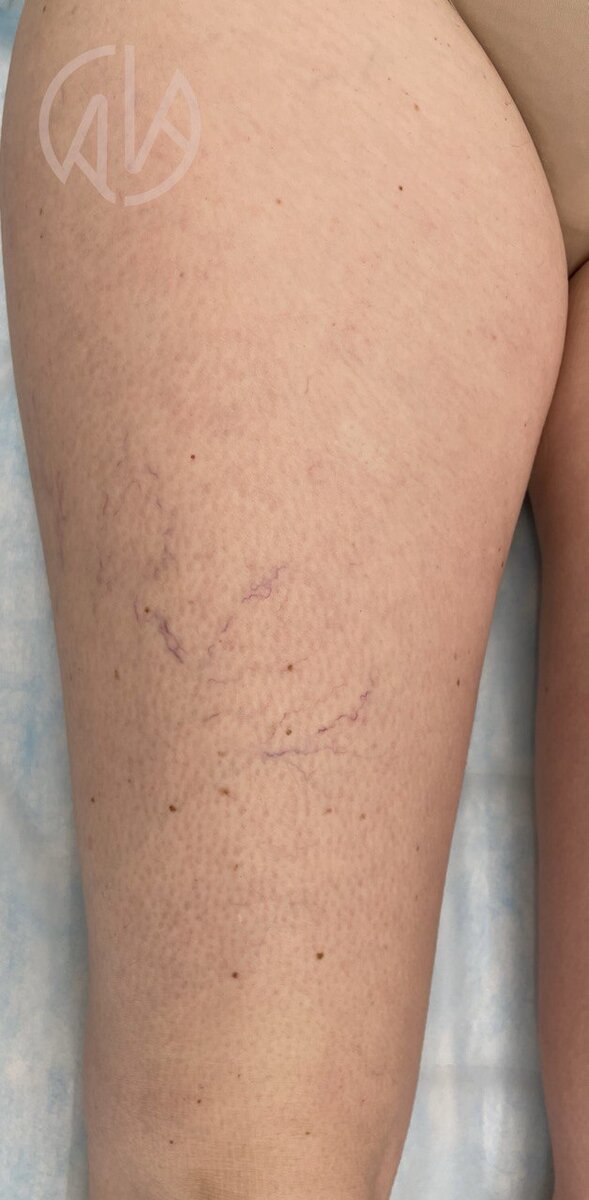 1-я стадия варикозной болезни