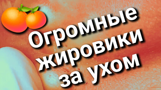 Выдавливание ЖИРОВИКОВ 🍊 за ухом. Косметолог очень 