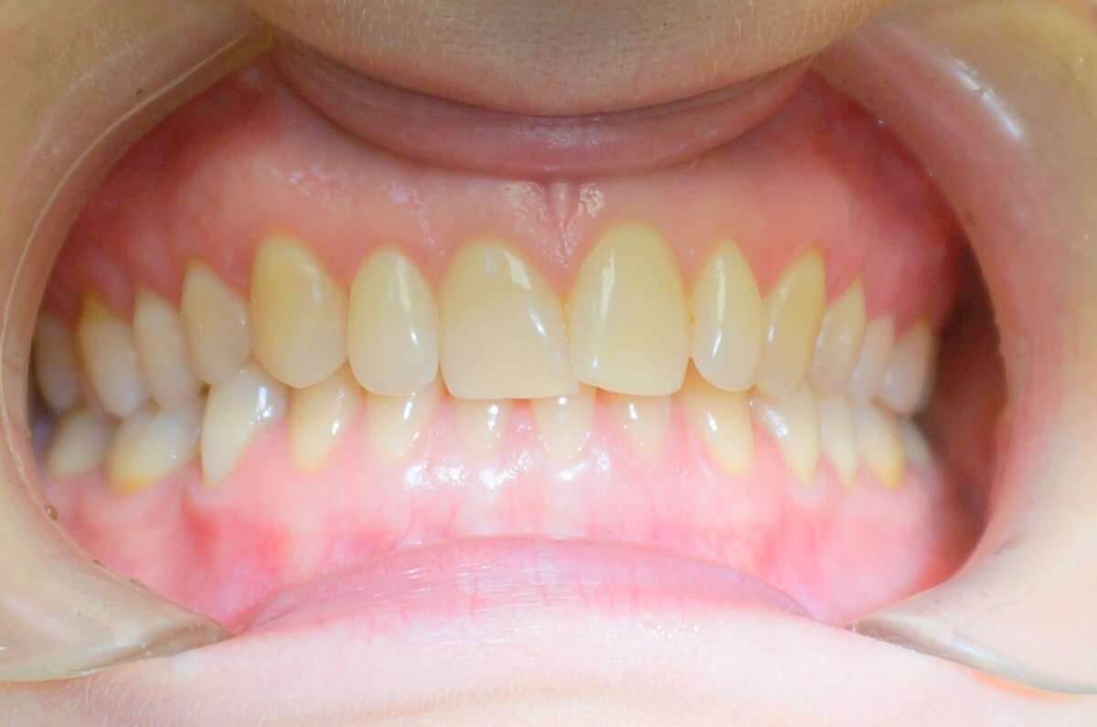 После смены зубов в постоянном прикусе