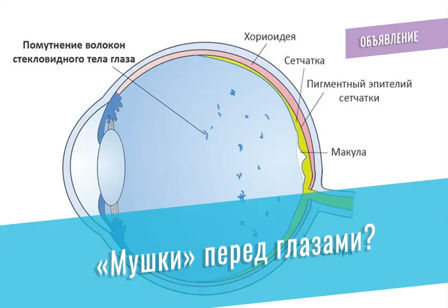 Отслоение задней стенки стекловидного тела глаза лечение