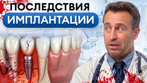 ЧТО может ПОЙТИ НЕ ТАК после ИМПЛАНТАЦИИ зубов? / Самые частые жалобы после операции на зубы