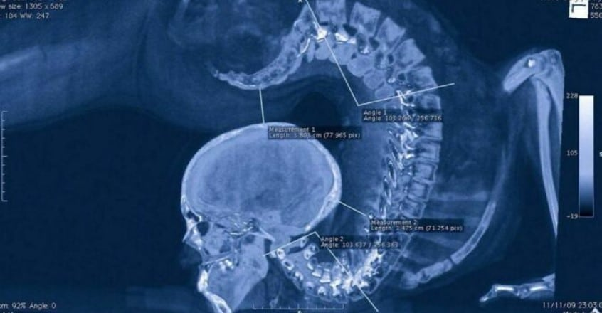 Рентгеновский снимок гимнастки
