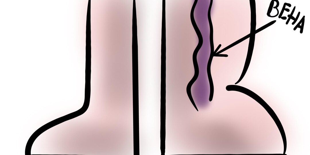 Почему компрессионные чулки не позволяют образовываться тромбам?