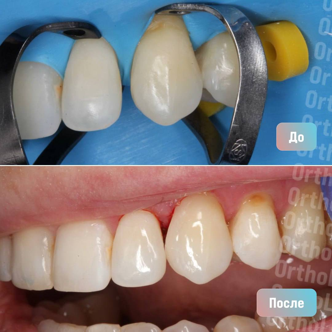 Закрытие промежутка между зубами: до и после лечения