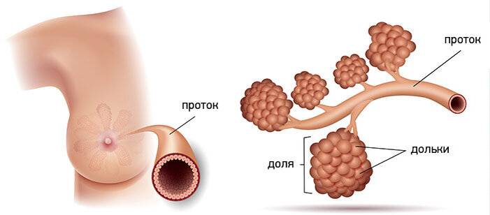 Внутрипротоковый рак молочной железы