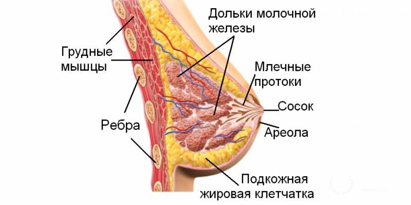 Папиллярный рак молочной железы