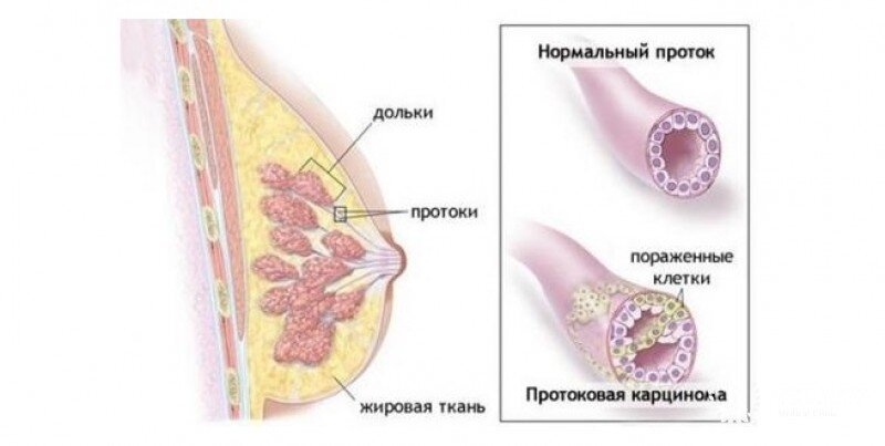 Инвазивный протоковый рак молочной железы