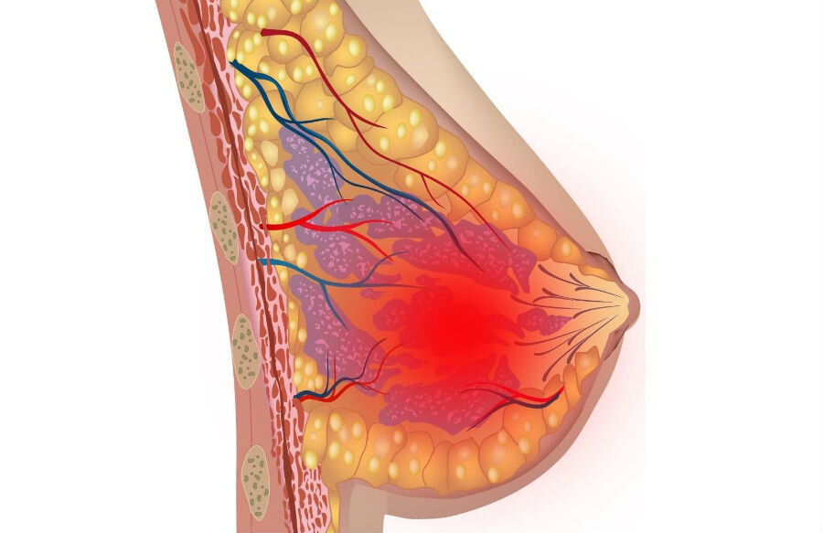 Воспалительный рак молочной железы