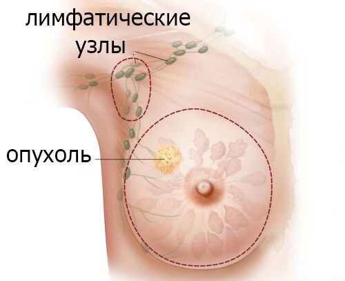 Филлоидная опухоль