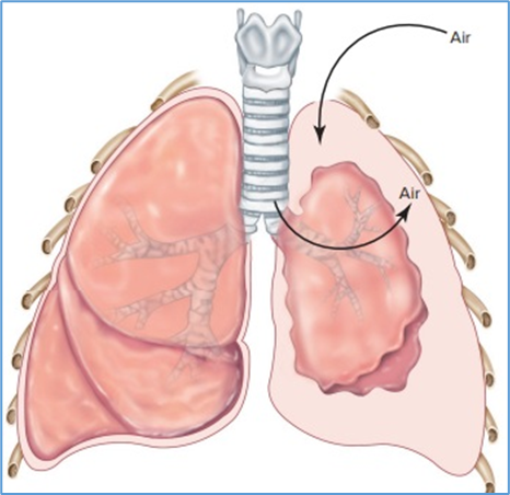 Figure 7.2. Pneumothorax. The lung collapses as air enters from   the pleural cavity either from inside the lung or from the atmosphere through   the thoracic wall. The combination of lung elastic recoil and surface tension   causes collapse of the lung when pleural and airway pressures equalize. Eric   P. Widmaier Human Physiology. The Mechanisms of Body Function, New NY:   McGraw-Hill Education. 2019. https://lccn.loc.gov/2017048599